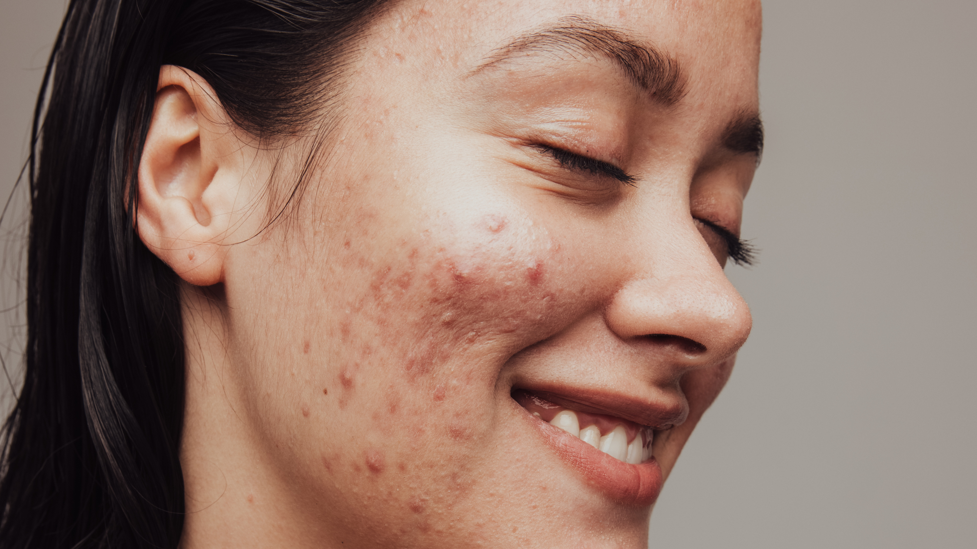 The Acne Edit - Loshen & Crem