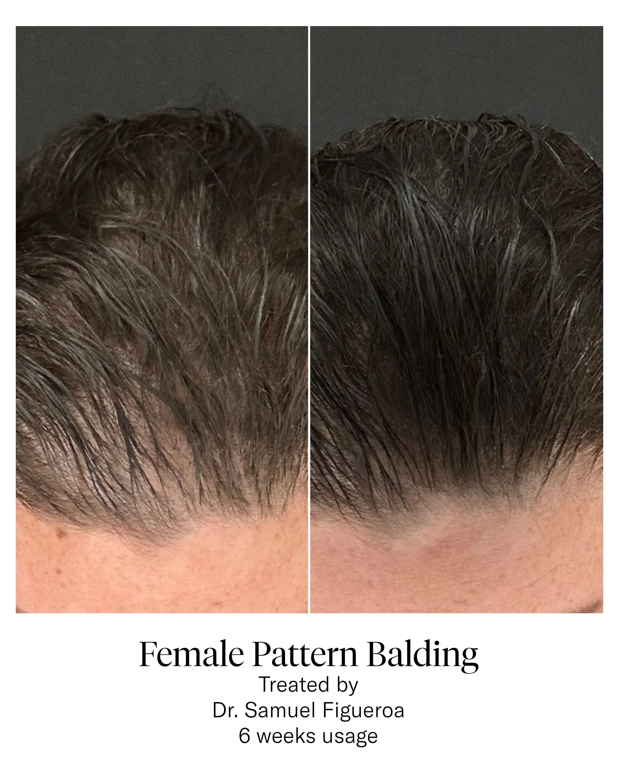 Calecim® Advanced Hair System | Hair loss | LOSHEN & CREM