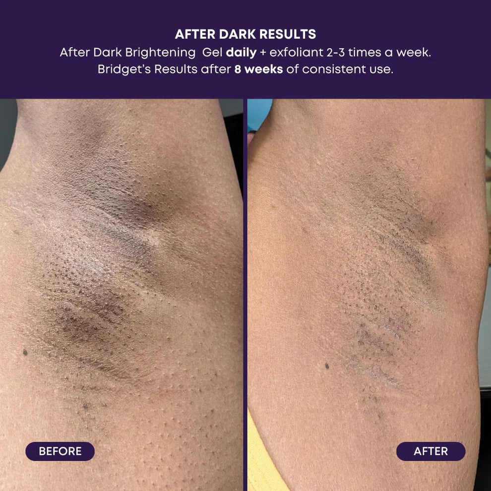 After Dark Brightening Gel | Bikini - Hyperpigmentation | LOSHEN & CREM