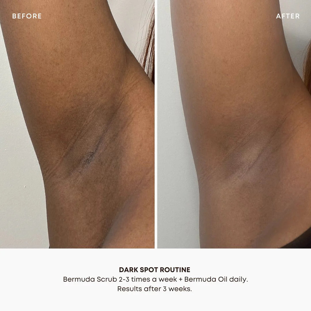 Dark Spot Oil – Bermuda | Bikini - Hyperpigmentation | LOSHEN & CREM
