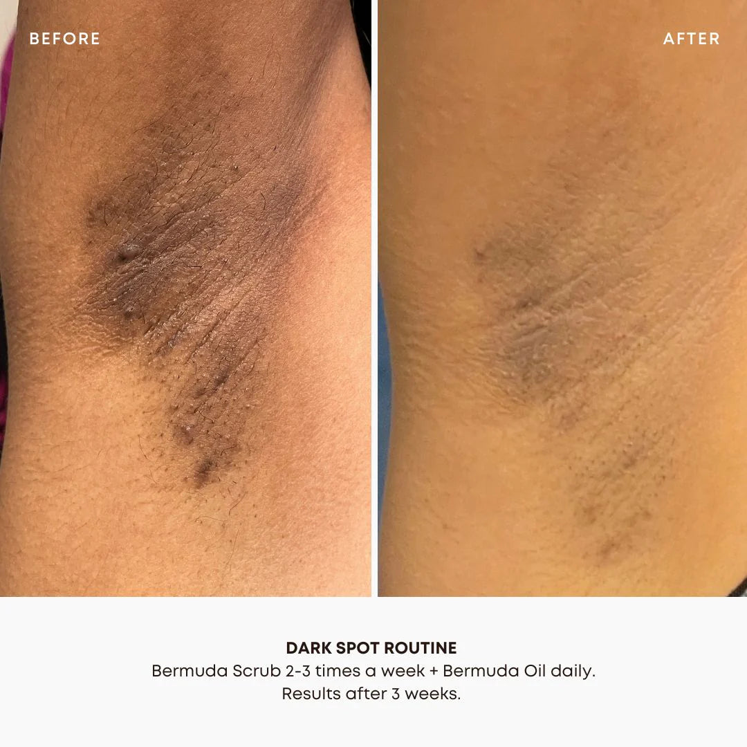Dark Spot Oil – Bermuda | Bikini - Hyperpigmentation | LOSHEN & CREM
