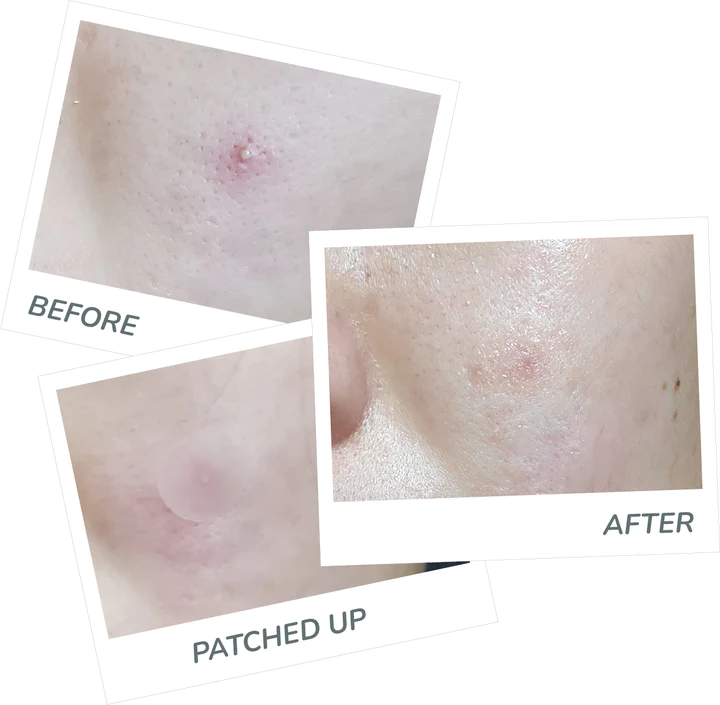 EXZIT PATCH | Pimple patch | LOSHEN & CREM