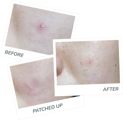 EXZIT PATCH | Pimple patch | LOSHEN & CREM
