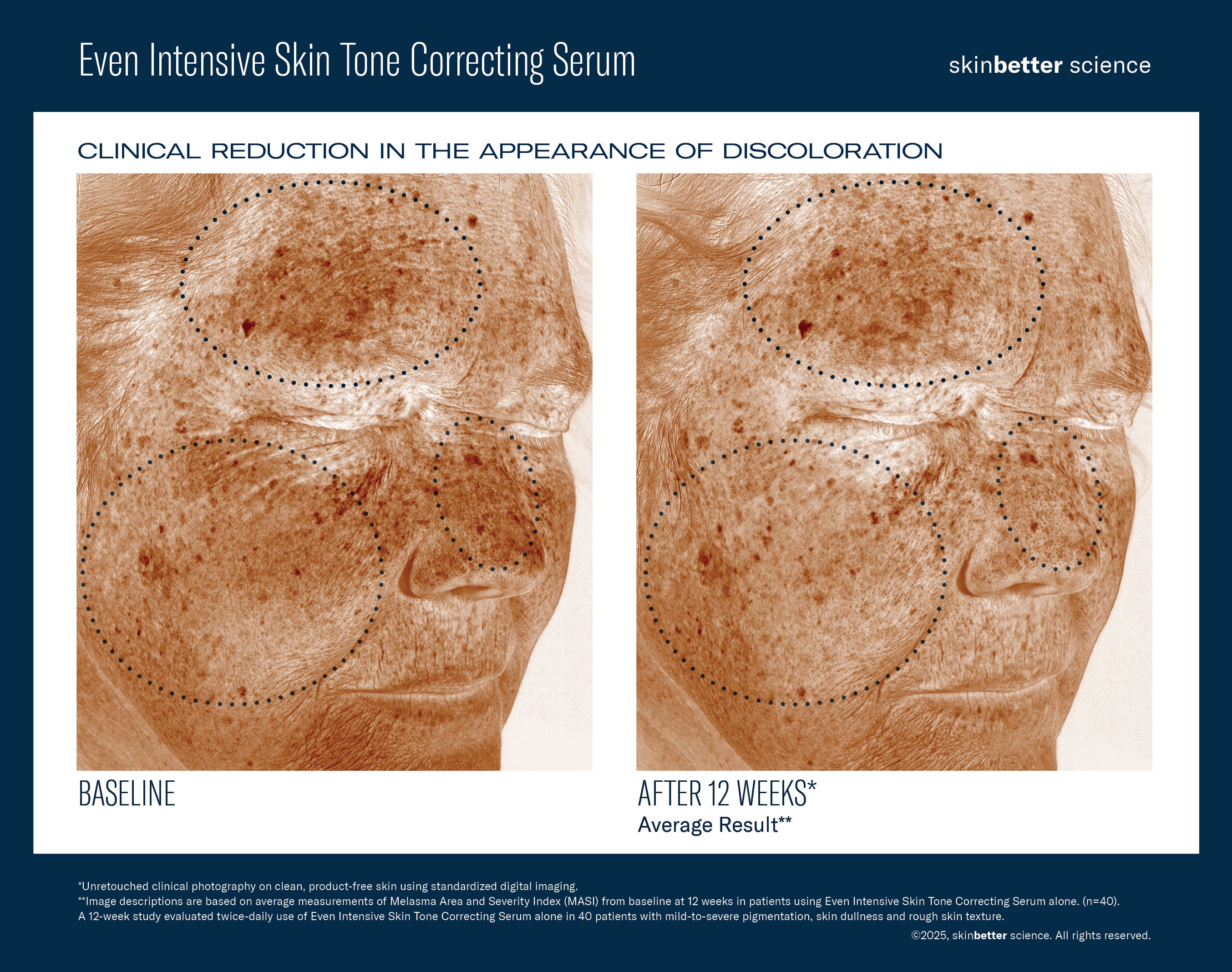 Even Intensive Skin Tone Correcting Serum | Hyperpigmentation serum | LOSHEN & CREM