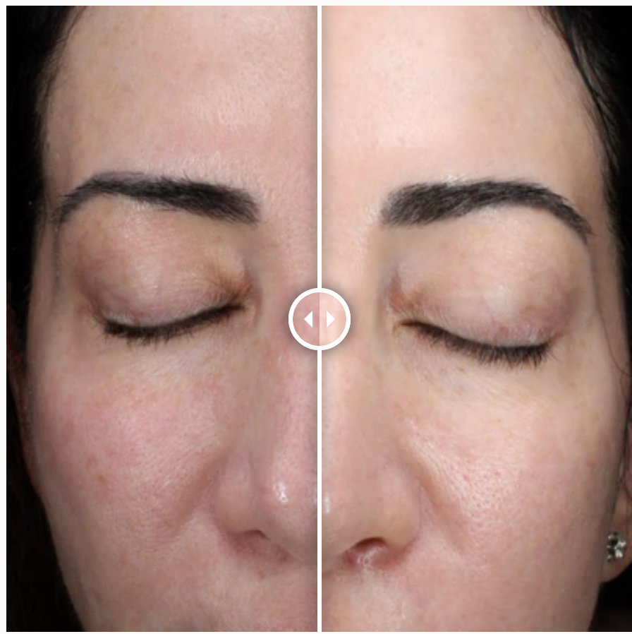 Alastin HA (Hyaluronic Acid) IMMERSE Serum™