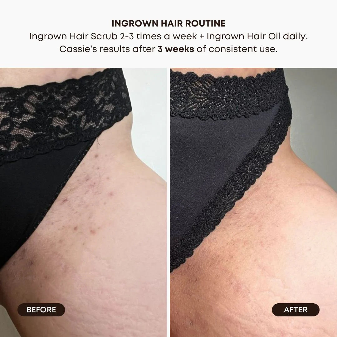 Ingrown Hair Oil – Watermelon Sugar | Body - Ingrown solution | LOSHEN & CREM