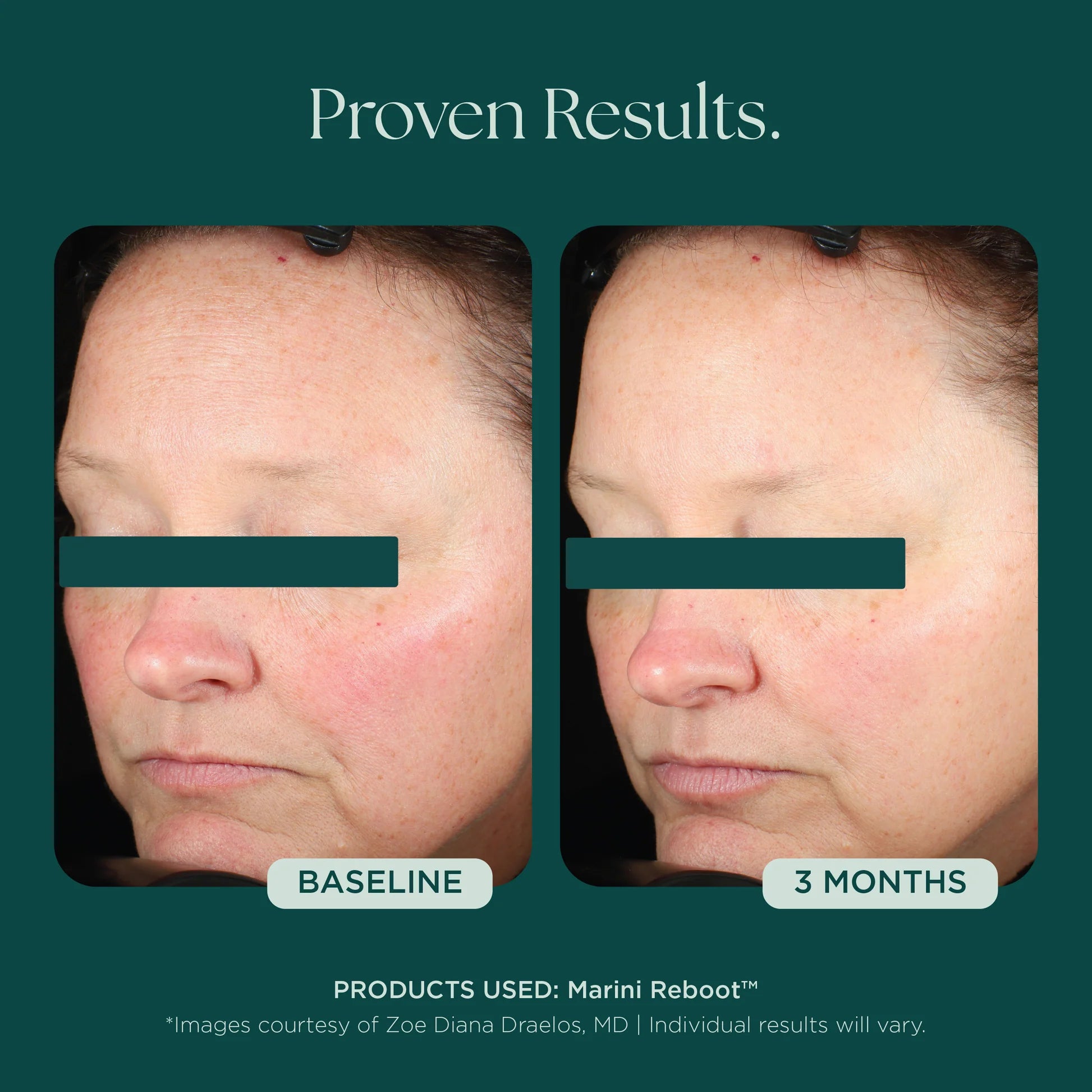 Marini Reboot™ PDRN Face Serum