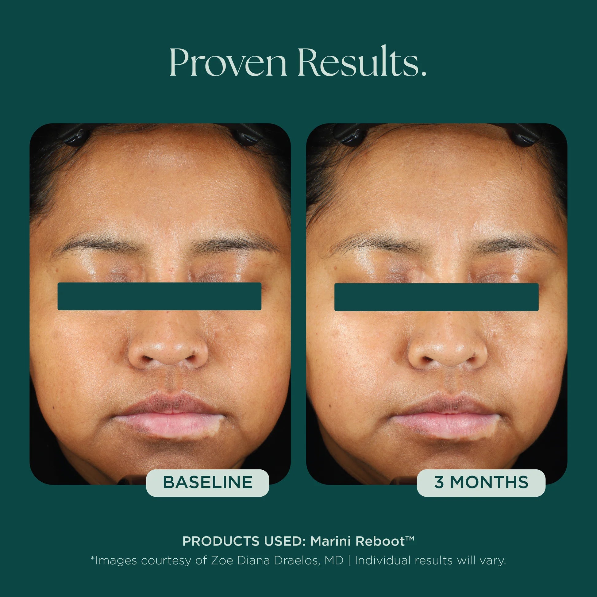 Marini Reboot™ PDRN Face Serum