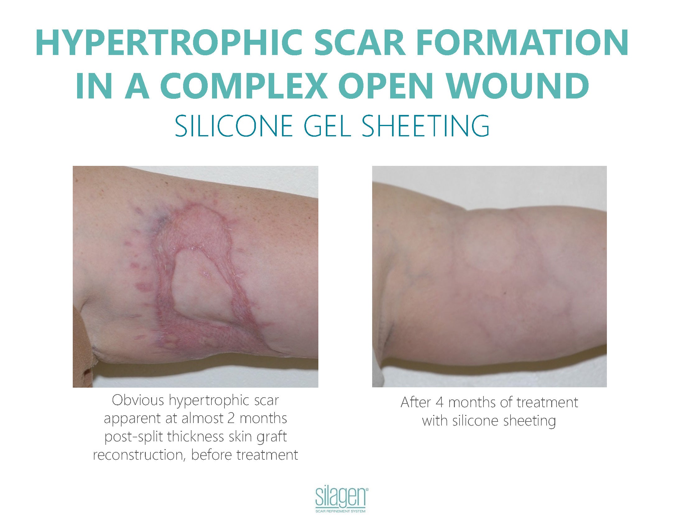 Silagen® 100% Pure Silicone gel for scars