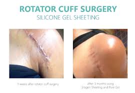 Silagen® 100% Pure Silicone gel for scars