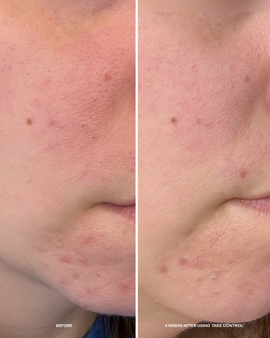 Take Control™ Salicylic + 10% Azelaic Acid Clarifying Serum