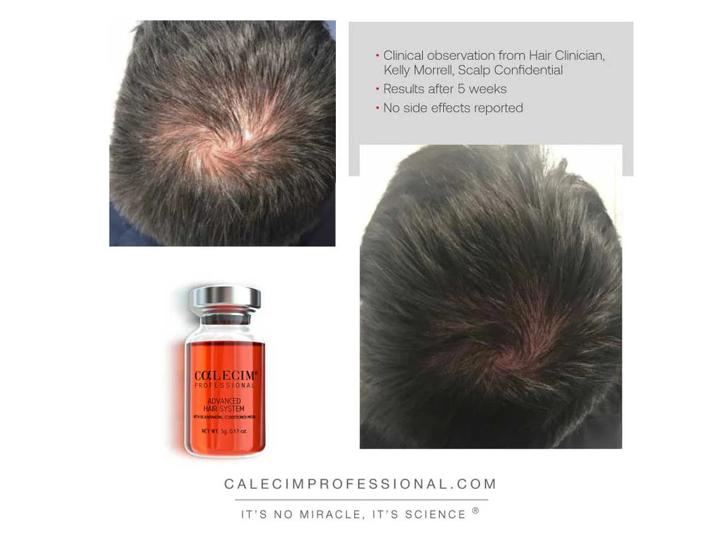 Calecim® Advanced Hair System | Hair loss | LOSHEN & CREM