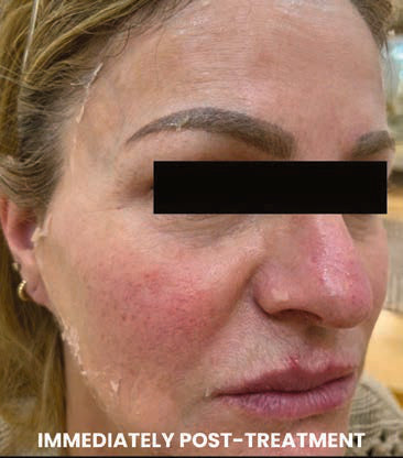 Immediately after one 45-minute CO2Lift PRO treatment. Manufacturer-published case; Samantha Lucero-Daga, DNP, MSN-C. Individual results vary.