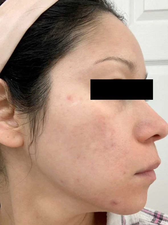 Calecim® Professional Pigment Solution | Hyperpigmentation serum | LOSHEN & CREM