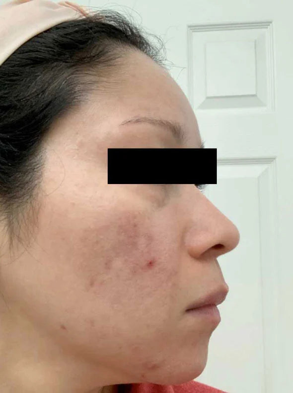 Calecim® Professional Pigment Solution | Hyperpigmentation serum | LOSHEN & CREM