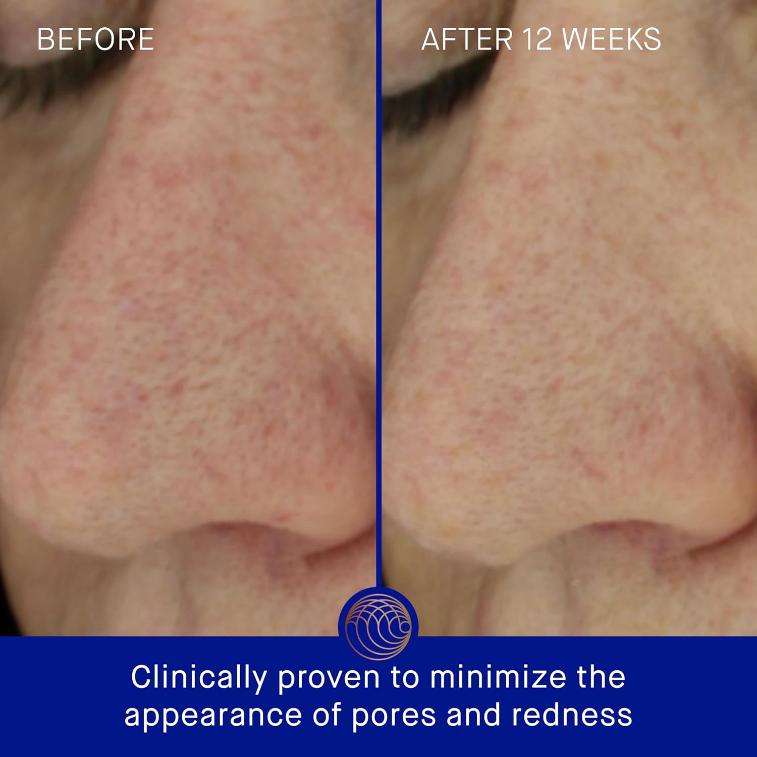 Before-and-after comparison of a person's nose area showing reduced pore appearance and redness after 12 weeks, with text reading 'BEFORE', 'AFTER 12 WEEKS', and a blue banner at the bottom.