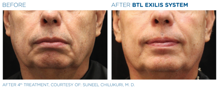 Référence BTL : bas du visage d’un homme avant et après quatre traitements, avec l’autorisation de Suneel Chilukuri, MD