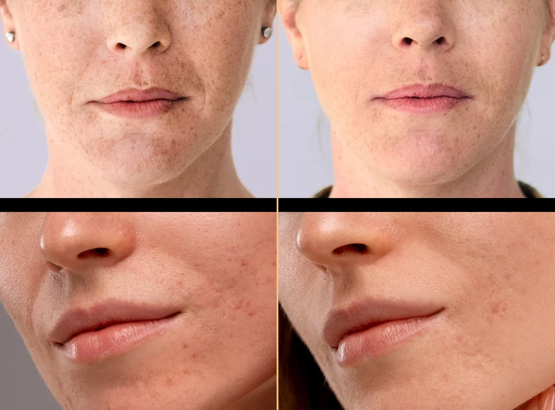 A four-panel before-and-after comparison collage showing close-up views of a woman's lower face, focusing on the mouth, nose, and cheek area to demonstrate skincare results, likely for acne or hyperpigmentation treatment.