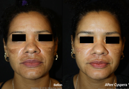 Cyspera® Intensive system | Hyperpigmentation system | LOSHEN & CREM