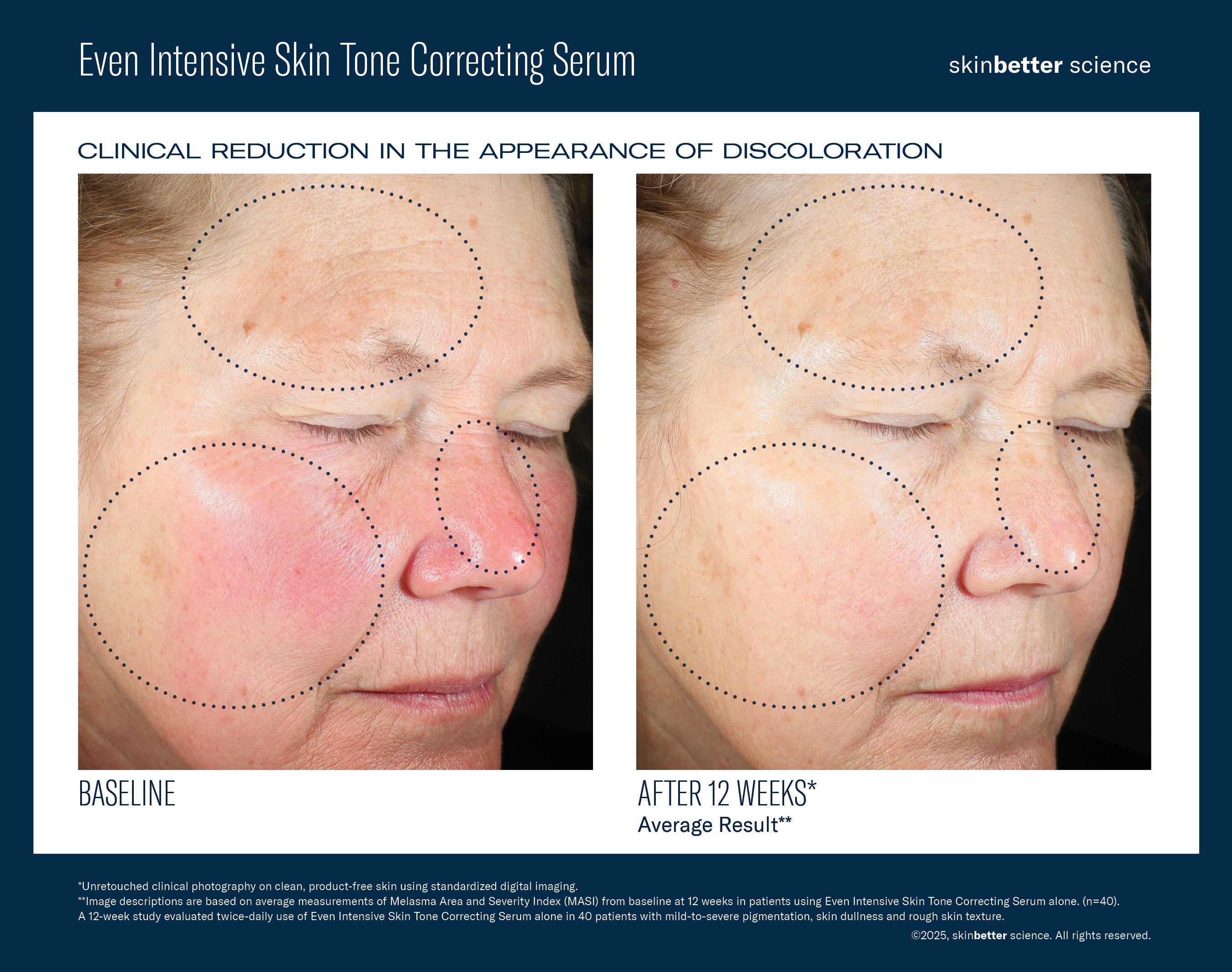 Even Intensive Skin Tone Correcting Serum | Hyperpigmentation serum | LOSHEN & CREM