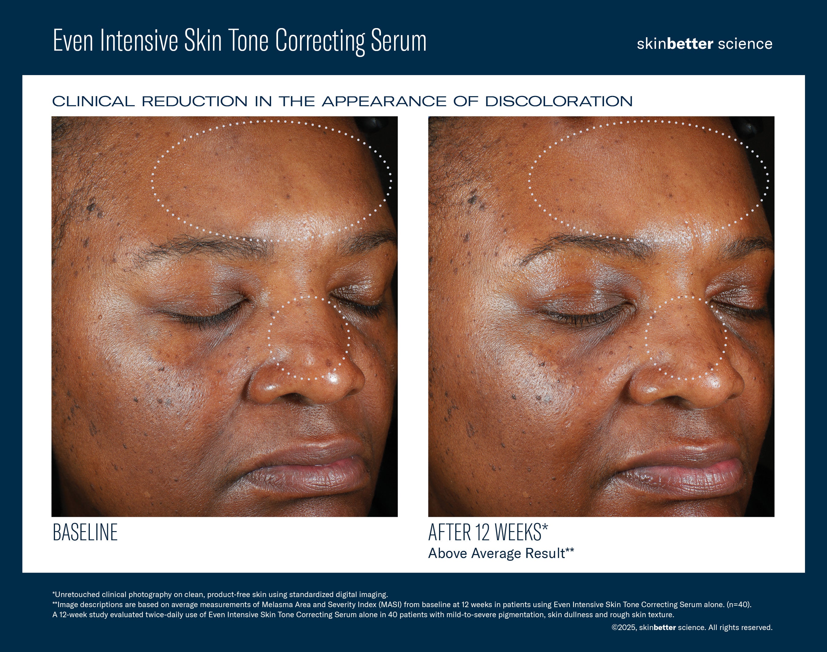 Even Intensive Skin Tone Correcting Serum | Hyperpigmentation serum | LOSHEN & CREM