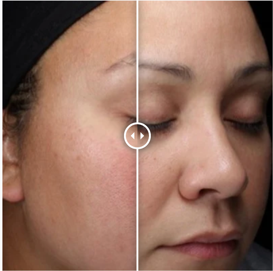 Alastin HA (Hyaluronic Acid) IMMERSE Serum™