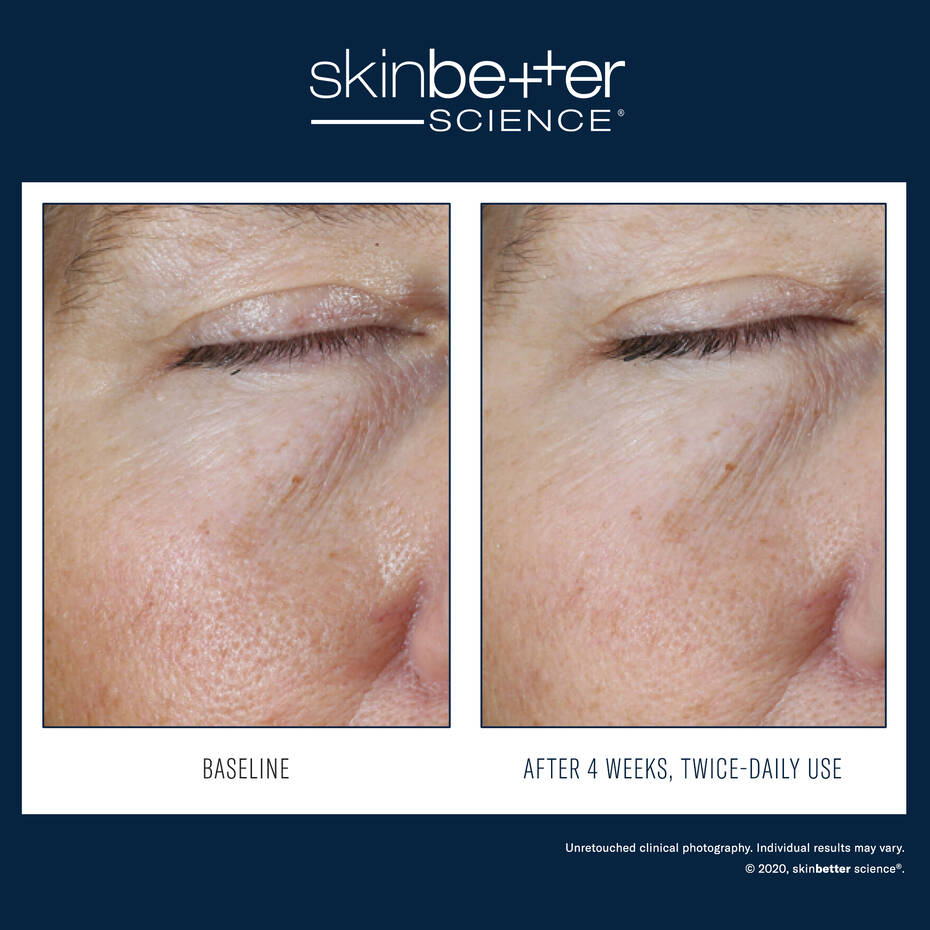 INSTANT EFFECT GEL EYE | Dark circles | LOSHEN & CREM