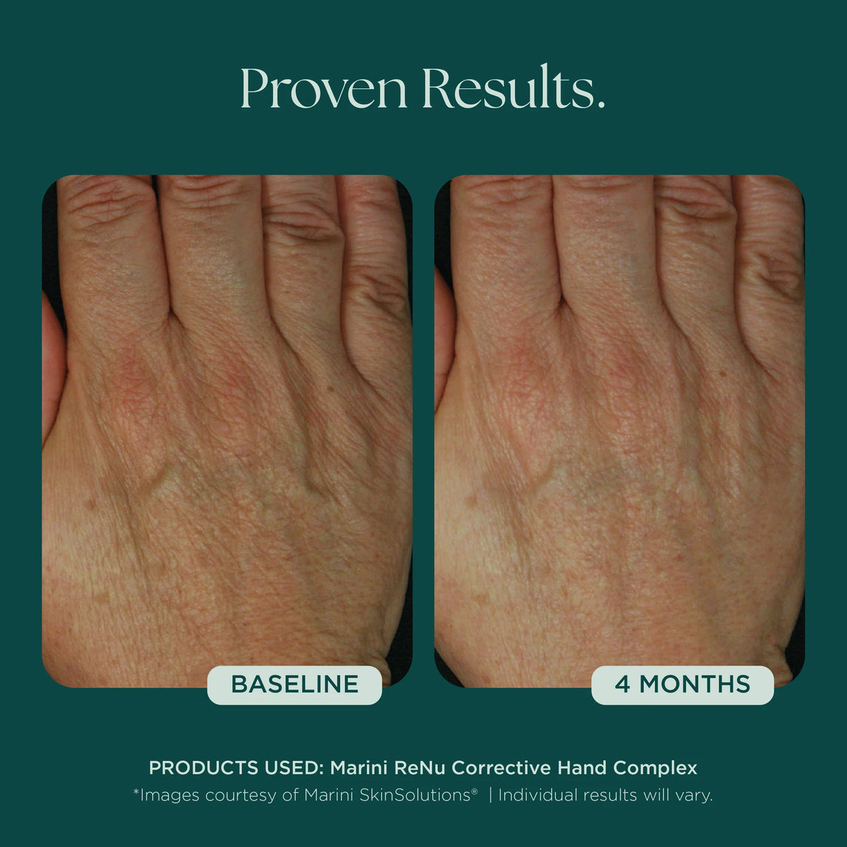 Marini ReNu Corrective Hand Complex | Hand - Cream | LOSHEN & CREM