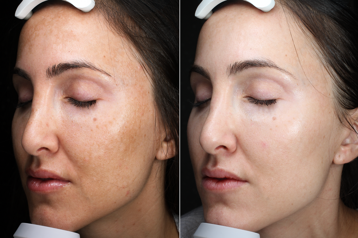 Existing MeLine before and after comparison, side view