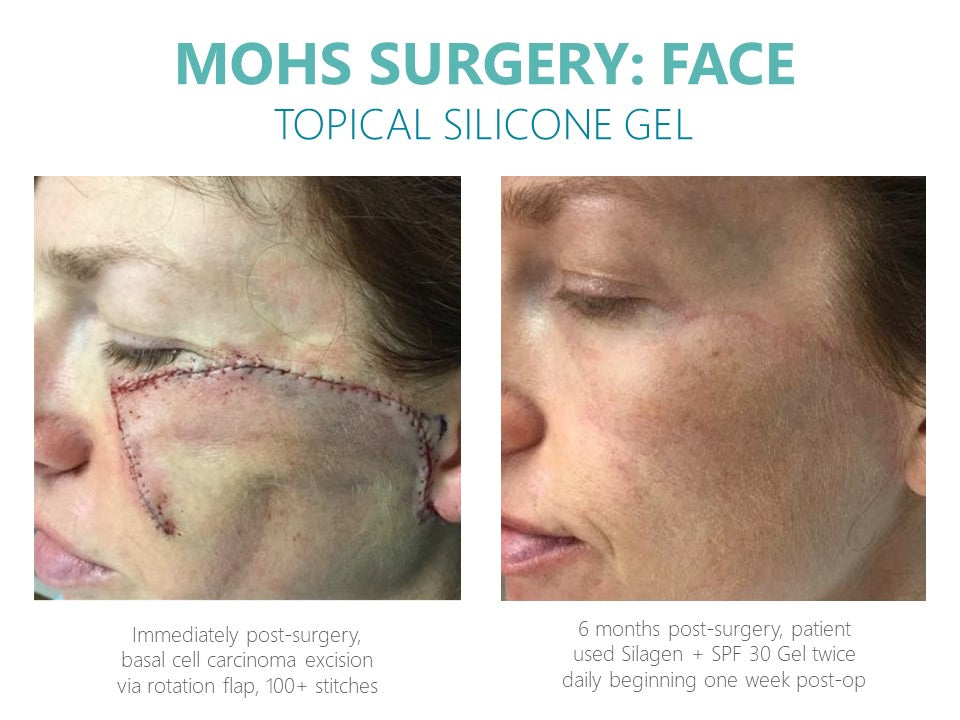 Silagen® 100% Pure Silicone gel for scars