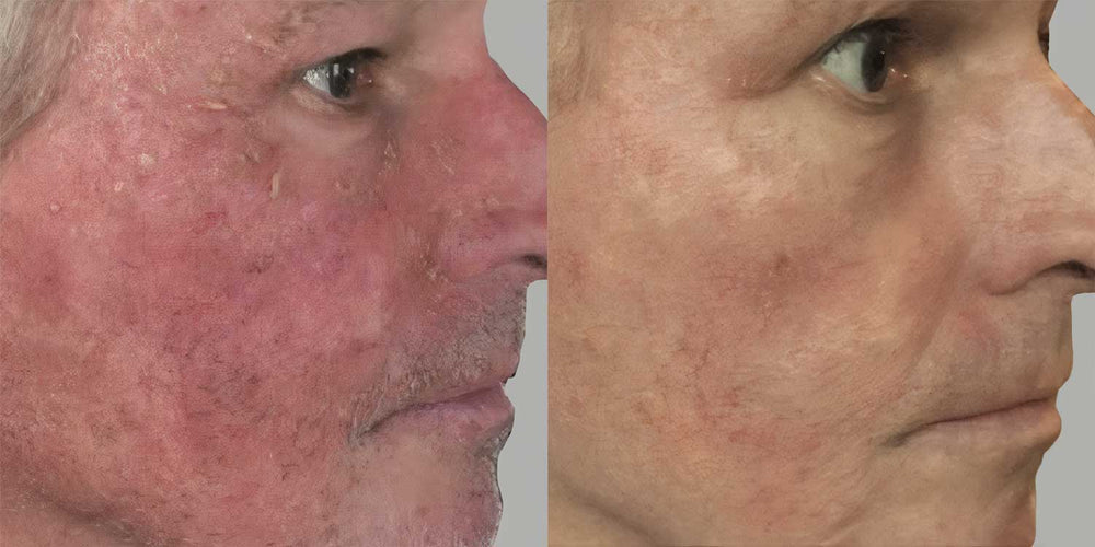 Deuxième comparaison originale AnteAGE d’une joue avant et après un mois, présentée par la marque comme un soin au sérum à domicile