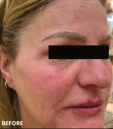 Before one CO2Lift PRO treatment. Manufacturer-published case; photo courtesy of Samantha Lucero-Daga, DNP, MSN-C.