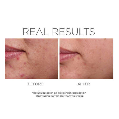 CORRECT | Acne Treatments & Kits | LOSHEN & CREM