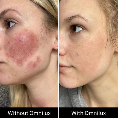 OMNILUX CONTOUR FACE | LED MASK | LOSHEN & CREM