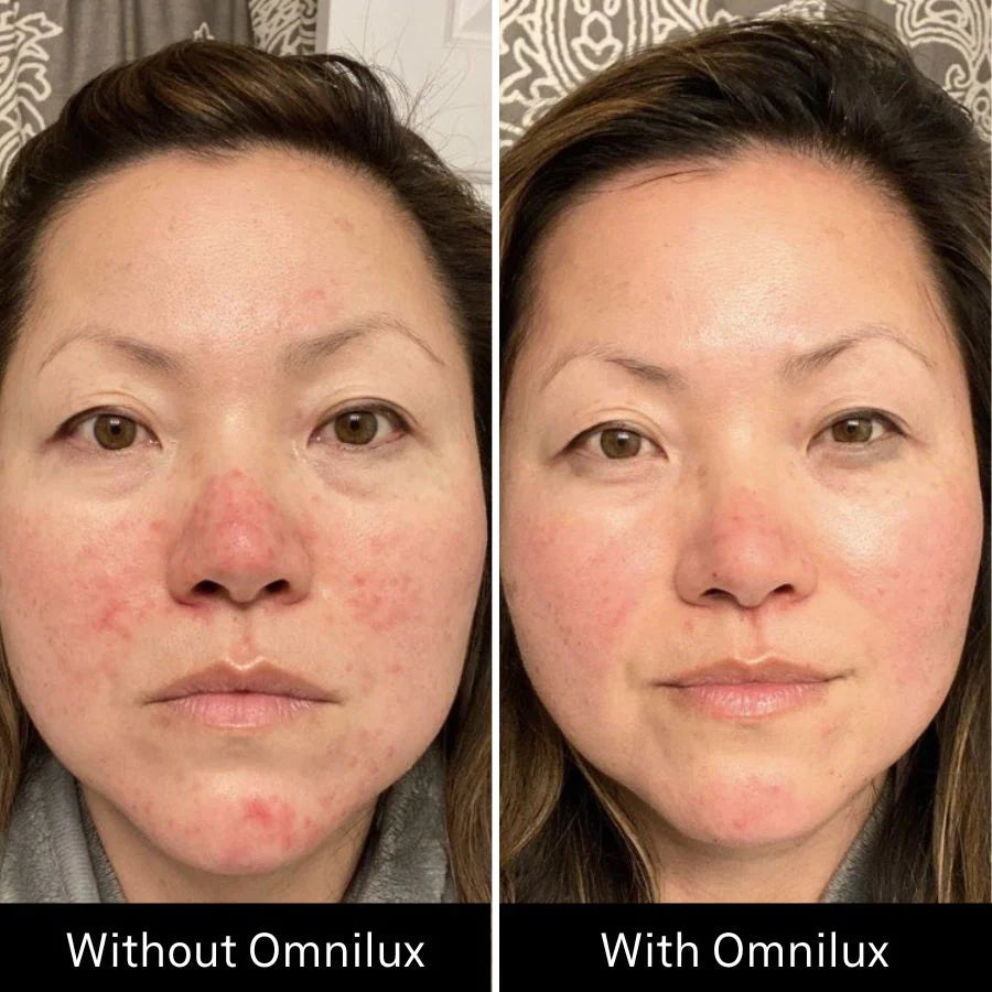 OMNILUX CONTOUR FACE | LED MASK | LOSHEN & CREM