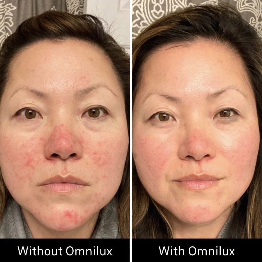 OMNILUX CONTOUR FACE | LED mask | LOSHEN & CREM